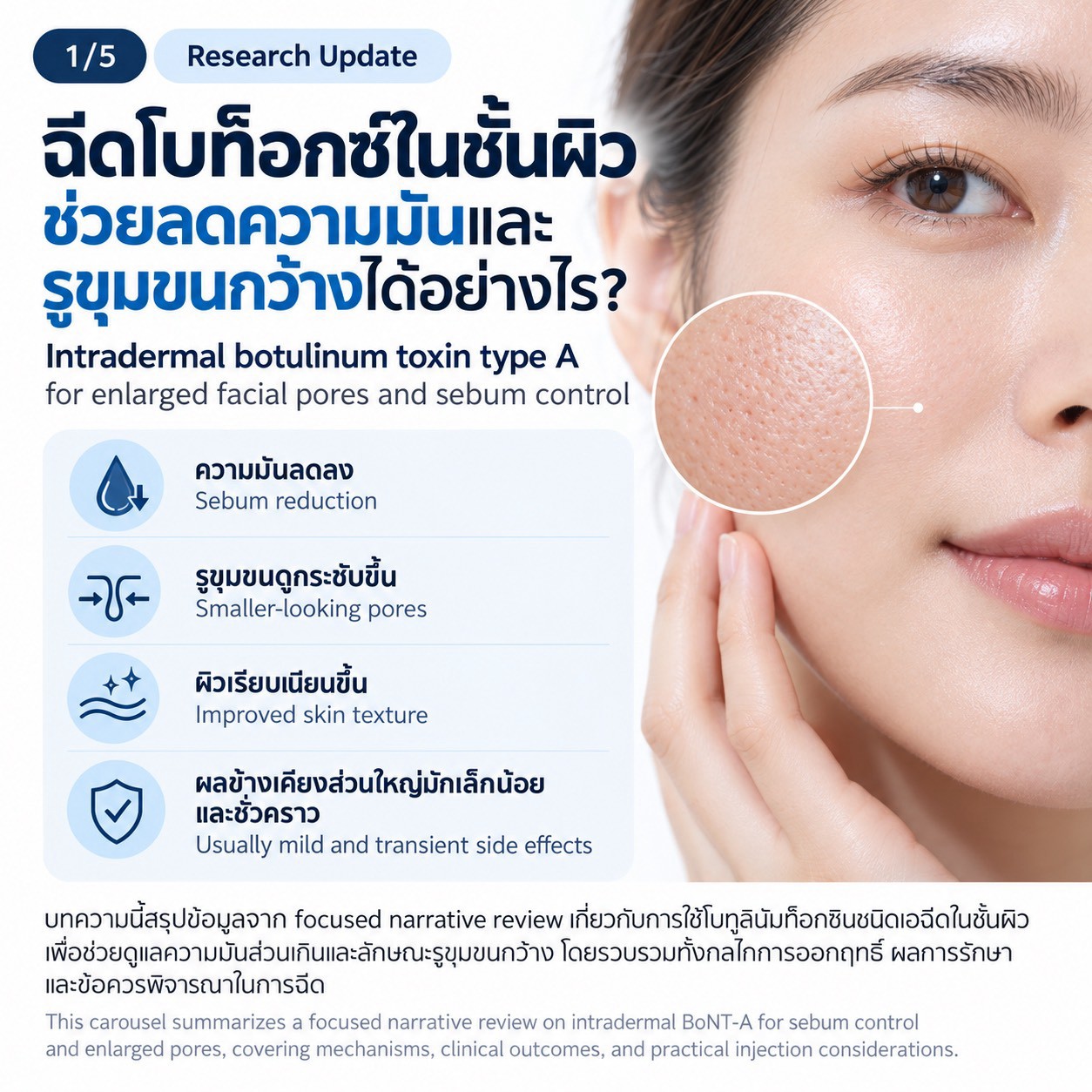 งานวิจัยทบทวน: การฉีด Botulinum Toxin Type A ในชั้นผิวเพื่อช่วยลดความมันและรูขุมขนกว้าง