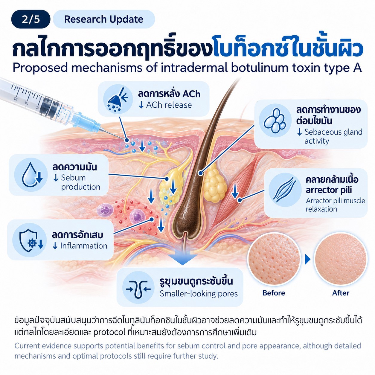 งานวิจัยทบทวน: การฉีด Botulinum Toxin Type A ในชั้นผิวเพื่อช่วยลดความมันและรูขุมขนกว้าง งานวิจัยทบทวน: การฉีด Botulinum Toxin Type A ในชั้นผิวเพื่อช่วยลดความมันและรูขุมขนกว้าง