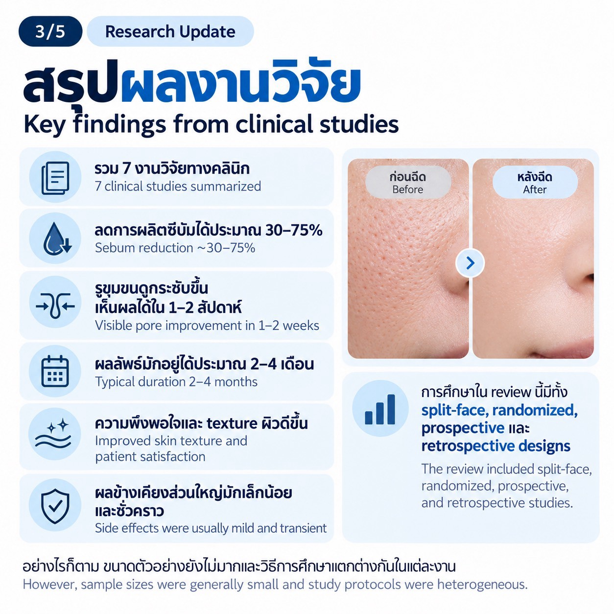 งานวิจัยทบทวน: การฉีด Botulinum Toxin Type A ในชั้นผิวเพื่อช่วยลดความมันและรูขุมขนกว้าง งานวิจัยทบทวน: การฉีด Botulinum Toxin Type A ในชั้นผิวเพื่อช่วยลดความมันและรูขุมขนกว้าง
