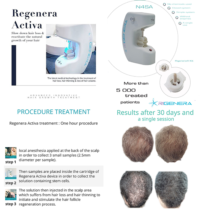 ดูแลผมร่วง ผมบางด้วย Regenera Hair Stem Cell Therapy !!