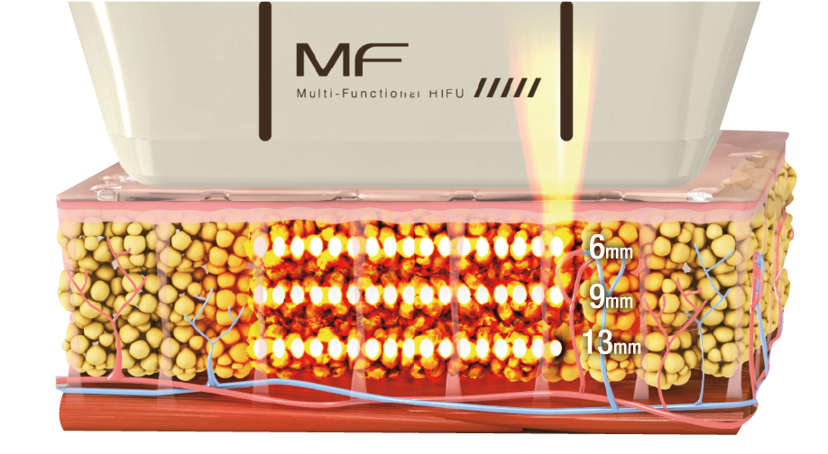 แนะนำเทคนิคดูแล ยกกระชับผิว: Ultraformer III นวัตกรรมคลื่นเสียงยกกระชับ ลดริ้วรอย กระชับผิว ดูแลหลุมสิวโดยไม่ต้องผ่าตัด แนะนำเทคนิคดูแล ยกกระชับผิว: Ultraformer III นวัตกรรมคลื่นเสียงยกกระชับ ลดริ้วรอย กระชับผิว ดูแลหลุมสิวโดยไม่ต้องผ่าตัด