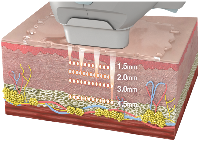 แนะนำเทคนิคดูแล ยกกระชับผิว: Ultraformer III นวัตกรรมคลื่นเสียงยกกระชับ ลดริ้วรอย กระชับผิว ดูแลหลุมสิวโดยไม่ต้องผ่าตัด แนะนำเทคนิคดูแล ยกกระชับผิว: Ultraformer III นวัตกรรมคลื่นเสียงยกกระชับ ลดริ้วรอย กระชับผิว ดูแลหลุมสิวโดยไม่ต้องผ่าตัด