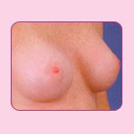 ศัลยกรรมผ่าตัดเสริมหน้าอก (Breast augmentation) โดย คลินิกหมอศุภชัย (หมอไก่)