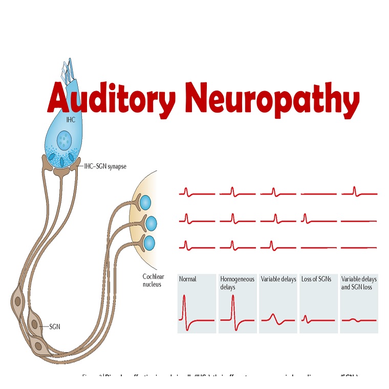 ความผิดปกติของการได้ยินจากความเสื่อมของระบบประสาท (AUDITORY NEUROPATHY)