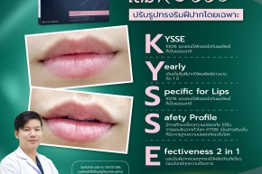 Restylane Kysse