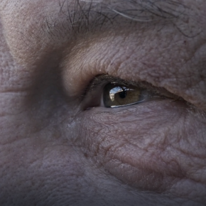 ถุงใต้ตาบวมใหญ่ แก้ด้วยฟิลเลอร์แล้วเป็นก้อน? ทำไมวัย 50+ ถึงควรเลือก ตัดถุงใต้ตาเทคนิค Eyelock แทน