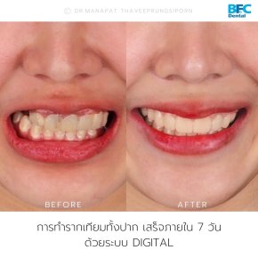 Full Mouth Implant Rehabilitation (for Upper Arch) With Full Digital Workflow in 7 Days 