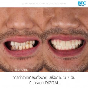 Full Mouth Dental Implants (All on 4 Dental Implants)