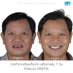 Smile Trasformation in 7 days with All-on-4 Implant