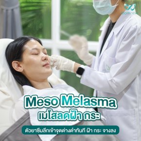 Meso Melasma เมโสลดฝ้า