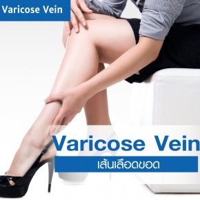 Varicose Vein Removal Program: The Symptoms and Solutions