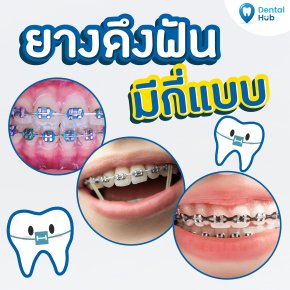 ฟอกฟันขาว คืออะไร ขาวจริงไหม? - dentalhubclinic ฟอกฟันขาว คืออะไร ขาวจริงไหม? - Dentalhubclinic
