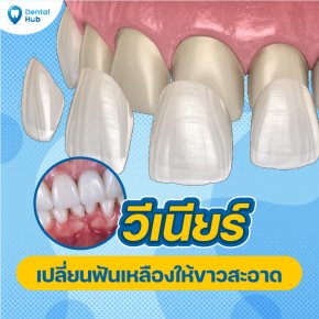วีเนียร์เปลี่ยนฟันเหลืองให้ขาวสะอาด