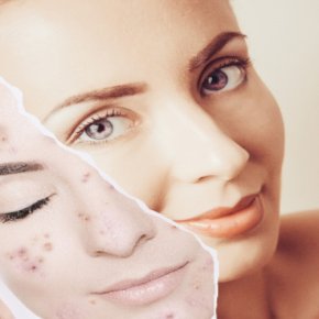 ตำรับยาไทย ใช้รักษาสิว