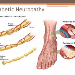 7 symptoms that signal that Diabetic nerves are damaged.