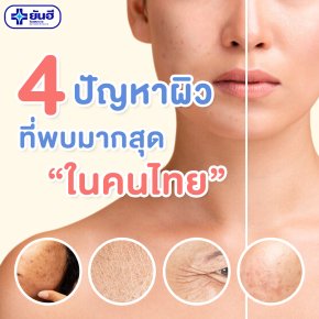 4 ปัญาหาผิว ที่พบมากสุดสำหรับคนไทย