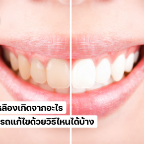 ฟันเหลือเกิดจากอะไร วิธีแก้ไขฟันเหลือ