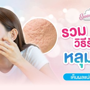 รวมวิธีรักษาหลุมสิว สิวหายแต่ทิ้งหลุมไว้ อยากหายต้องทำไงดี