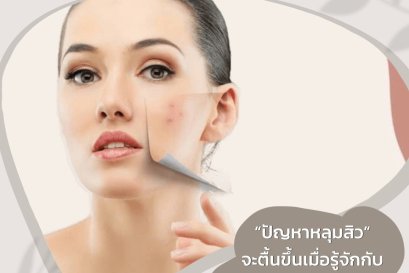 ปัญหาหลุมสิว” จะตื้นขึ้น เมื่อรู้จักกับ Skin Master Clinic
