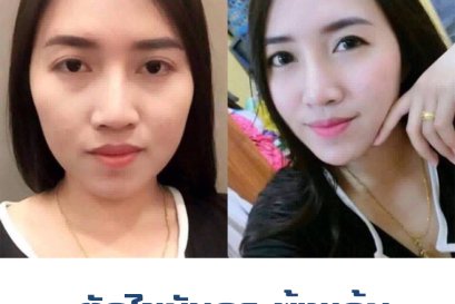 การผ่าตัดไขมันกระพุ้งแก้ม 