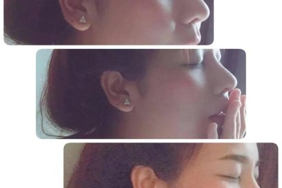 บทความ: ตัดปีกจมูก...ไม่น่ากลัว