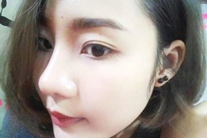 บทความ: หลังเสริมจมูกนอนตะแคงได้ไหม ? 