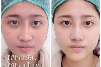 บทความ: ซิลิโคนลอยเป็นอันตรายจริงหรือหลอก ดูยังไงว่าลอยหรือเคลื่อน ? 