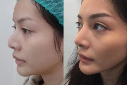 บทความ: 6 สิ่งที่เทคนิคอันเดอร์ไมน์วางใต้เยื่อหุ้มกระดูกทำได้เจ๋งไปเลย