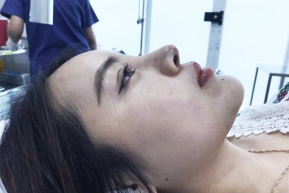 รีวิว: สาวน้อยบินไกลมาจากออสเตรเลียเพื่อเเก้จมูกด้วยเทคนิคปรับโครงสร้างจมูก