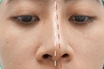 บทความ: เมื่อวางซิลิโคนไว้ตรงแกนจมูกเเล้ว เเต่ทำไมจมูกยังดูเอียงอยู่ดี