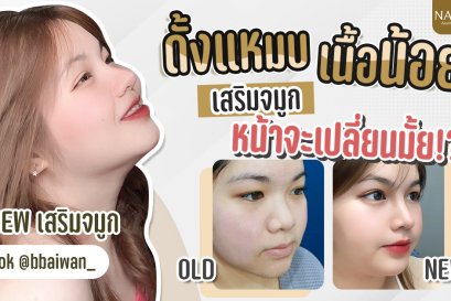 รีวิวเสริมจมูก กับพี่หมอดรีม