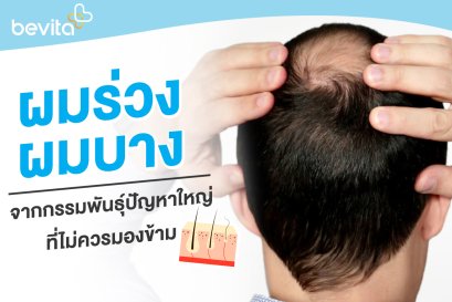 ผมร่วง ผมบางมาก จนหัวล้านปัญหาใหญ่ที่ไม่ควรมองข้าม