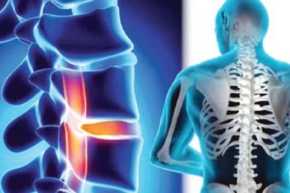 ما هو تضيق العمود الفقري بالفعل؟