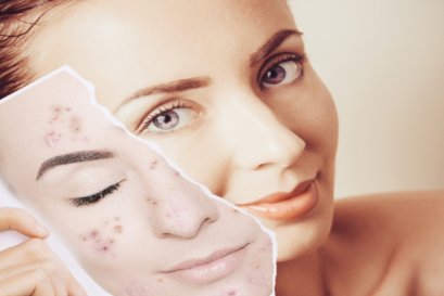 ตำรับยาไทย ใช้รักษาสิว