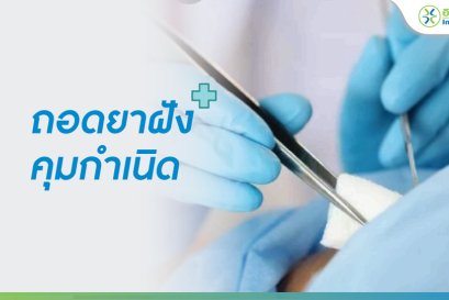 ถอดยาฝังคุมกำเนิด