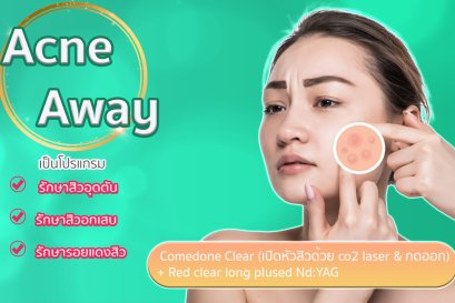 Acne A Way