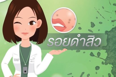 รอยดำสิว