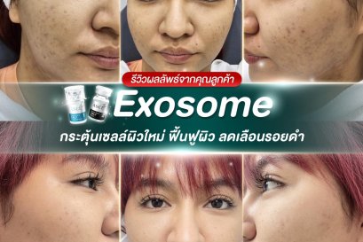 Exosome กระตุ้นสร้างคอลลาเจน