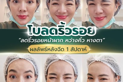  รีวิวผลลัพธ์ หลังฉีด Botox 