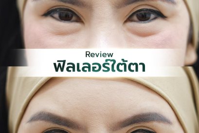 ฟิลเลอร์ใต้ตา