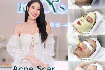 รักษาสิว Acne Scar Laser