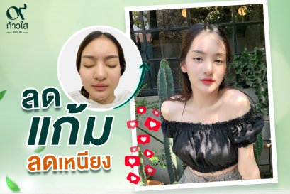 Meso Fat ลดแก้ม ลดเหนียง 