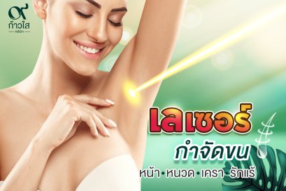 Laser กำจัดขน 