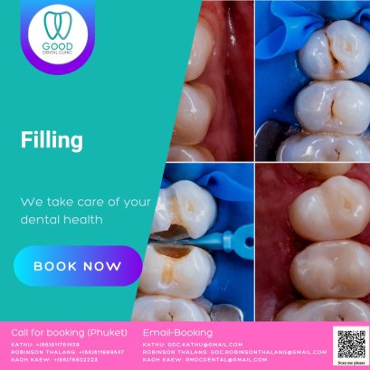 Dental Fillings