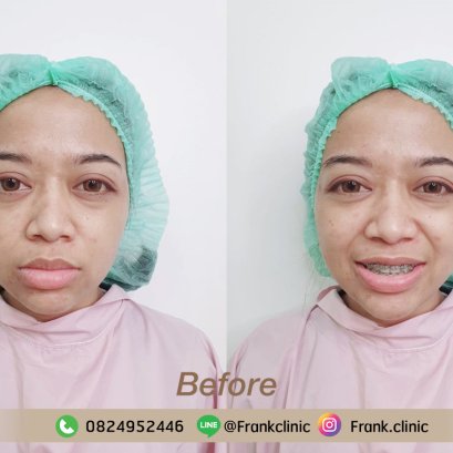 รีวิวดีดี เน้น เน้น วันต่อวันกับคุณ Marty ที่ได้ปากกระจับสวยรับกับตากลมโตของเธอ