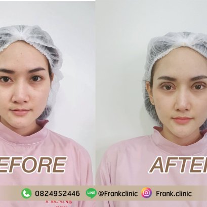 รีวิวจาก คุณตันหยง เปลี่ยนตาหมวย ให้เป็นสาวตาโตกลมแบ๊ว