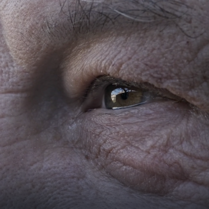 ถุงใต้ตาบวมใหญ่ แก้ด้วยฟิลเลอร์แล้วเป็นก้อน? ทำไมวัย 50+ ถึงควรเลือก ตัดถุงใต้ตาเทคนิค Eyelock แทน