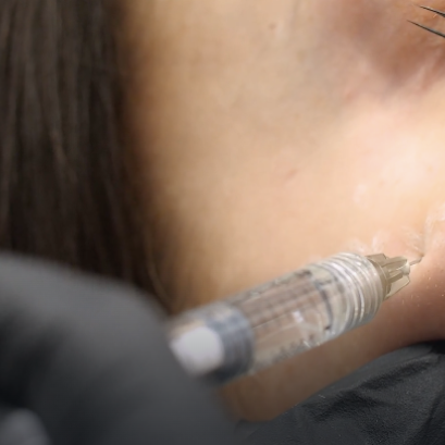 บอกลาการเติมฟิลเลอร์ใต้ตาตลอดชีวิต! ด้วยเทคนิค "จัดเรียงไขมันใต้ตา" แก้ถุงใต้ตาและร่องลึกในครั้งเดียว