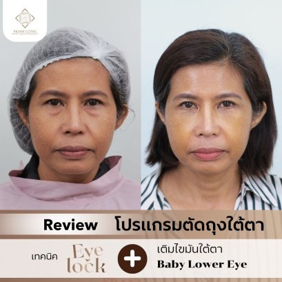 ร่องใต้ตาลึกจากกระดูกยุบตัว... ทำไมแค่ "ตัดถุงใต้ตา" อย่างเดียวถึงไม่พอสำหรับวัย 50+?