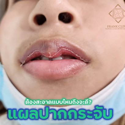 3 เคล็ดลับง่ายๆ ดูแลแผลหลังทำศัลยกรรมปากกระจับ โดย หมอนิโกะ